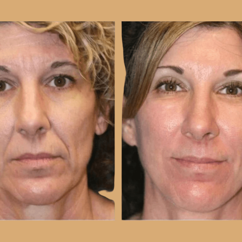 ClearGlo Beauty™ Premium Aura Glo Mask